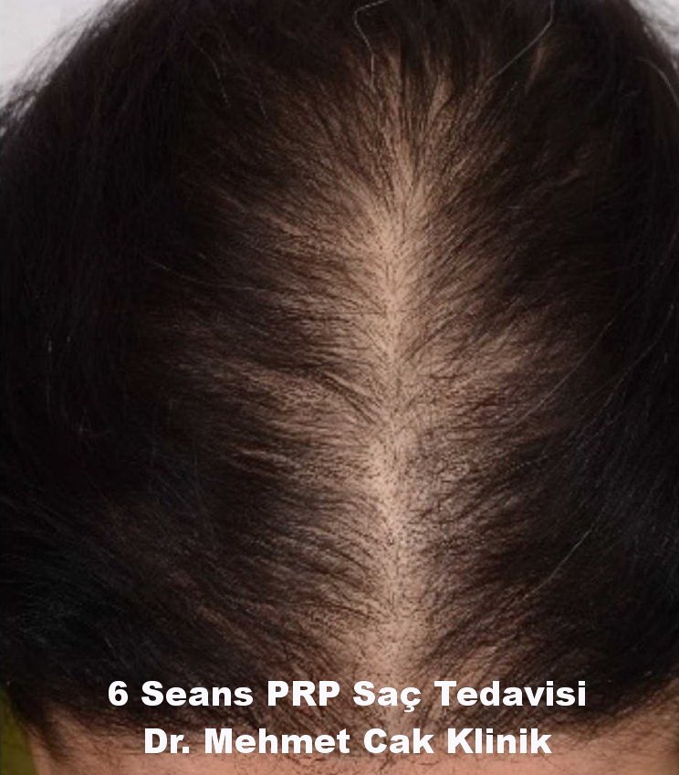 Prp Saç Tedavisi | WWW İstanbul