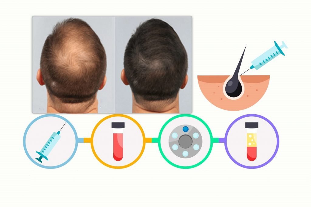 Saç Dökülmesi Prp Tedavisi | WWW İstanbul